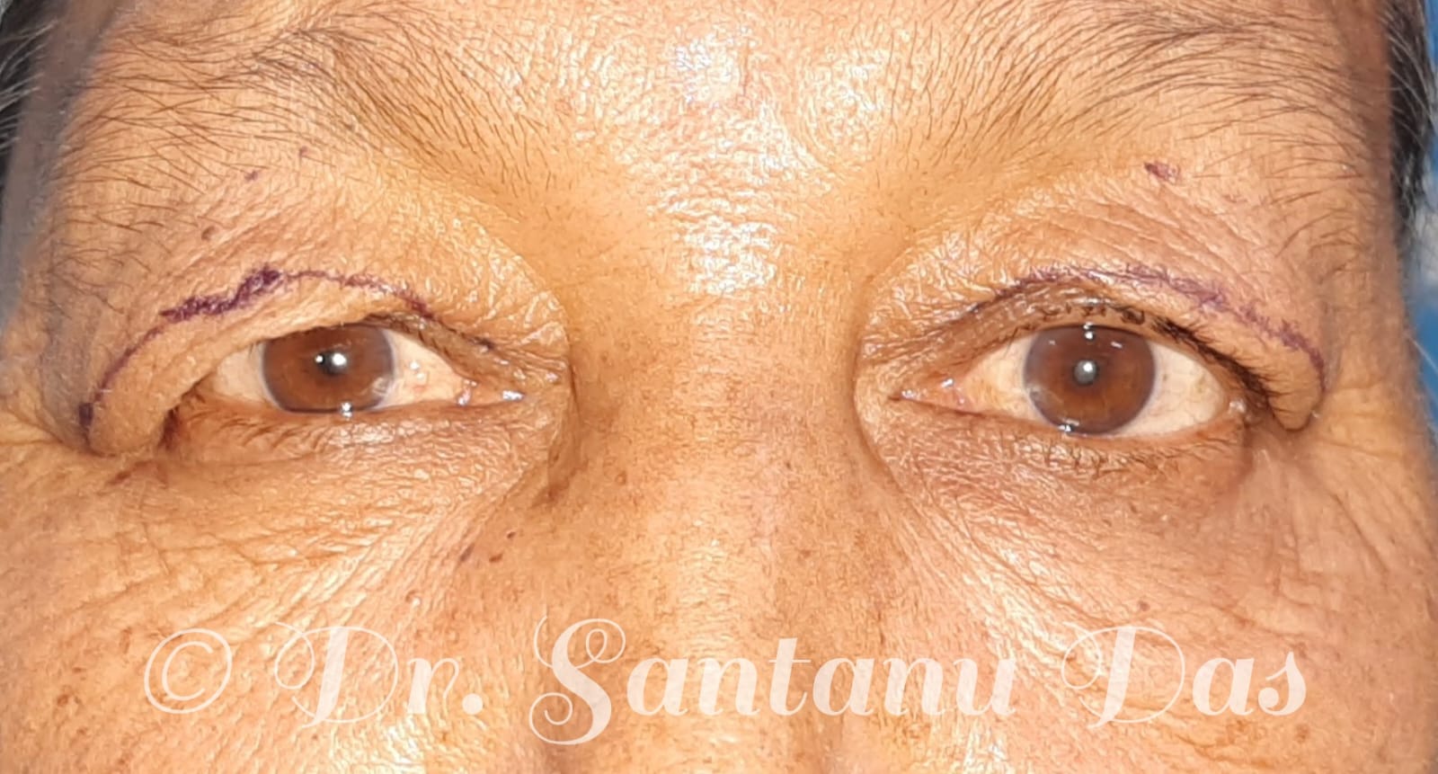 Thyroid Eye Disease View 1